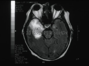 Herpes simplex virus encephalitis
