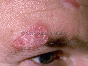 Discoid lupus erythematosus