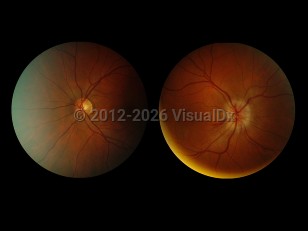 Optic neuritis