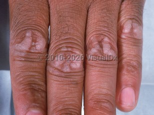 Focal acral hyperkeratosis