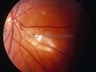 Ophthalmic Imaging image of Cytomegalovirus retinitis - imageId=6210113. Click to open in gallery. 