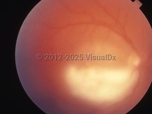 Ophthalmic Imaging image of Toxoplasmosis - imageId=6210403. Click to open in gallery. 