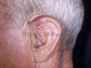 Clinical image of Chronic hematoma of pinna - imageId=6243584. Click to open in gallery.  caption: 'A deformed auricle.'