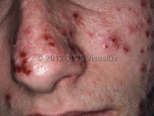 Clinical image of Hydroa vacciniforme - imageId=6244963. Click to open in gallery.  caption: 'Multiple crusts and a few faint pink papules on the central face.'