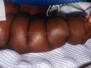 Clinical image of Michelin tire baby syndrome - imageId=6314793. Click to open in gallery.  caption: 'Increased arm, hand, and finger girth with multiple circumferential skin folds on the arm.'