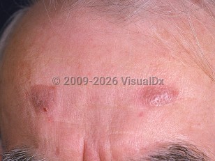 Granuloma faciale