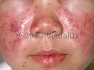 Systemic lupus erythematosus