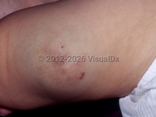 Clinical image of Venous malformation - imageId=6344838. Click to open in gallery.  caption: 'An ill-defined faintly blue tumor with overlying superficial, red vascular papules on the thigh.'