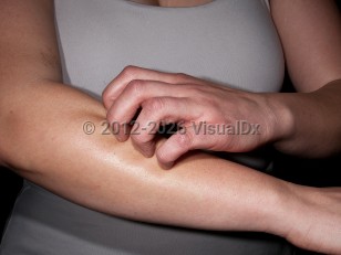 Pruritus without rash