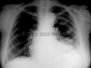 Paragonimiasis