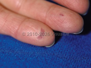 Clinical image of Limited cutaneous systemic sclerosis - imageId=64099. Click to open in gallery.  caption: 'Violaceous, telangiectatic macules on the fingers.'