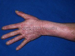 Chronic actinic dermatitis