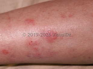 Cytomegalovirus infection