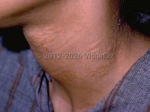 Pseudoxanthoma elasticum