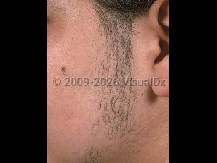 Hirsutism