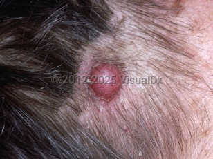 Cutaneous leiomyosarcoma