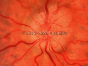 Idiopathic intracranial hypertension