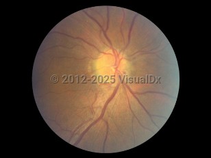 Anterior ischemic optic neuropathy