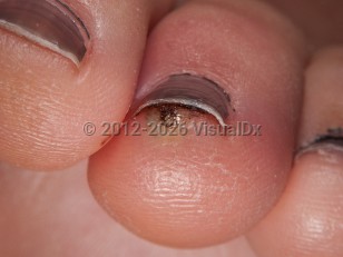 Tungiasis