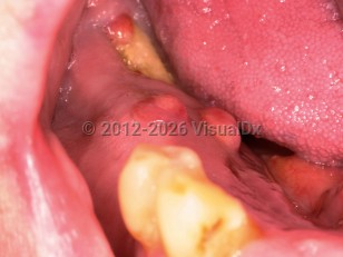 Bisphosphonate-related osteonecrosis of the jaw