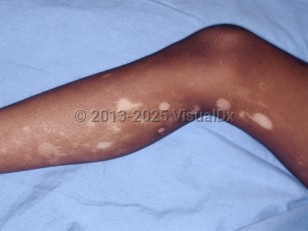 Segmental vitiligo