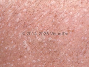 Stucco keratosis