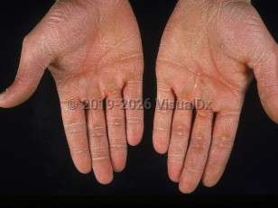 Palmoplantar keratoderma