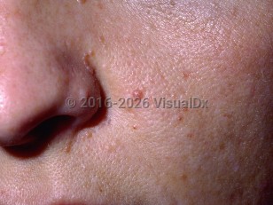 Tuberous sclerosis