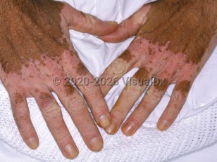 Chemical leukoderma
