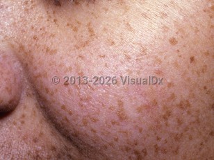 Clinical image of Ephelides - imageId=6736522. Click to open in gallery.  caption: 'Myriad tan macules on the face.'