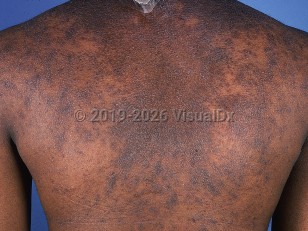 Infundibulofolliculitis