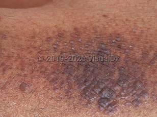 Lichen amyloidosis
