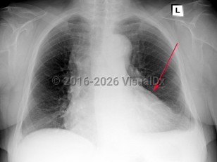 Pericarditis