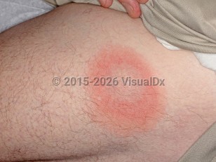 Southern tick-associated rash illness