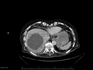 Pyogenic liver abscess