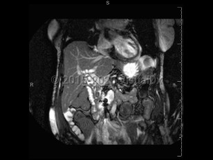 Acute cholangitis