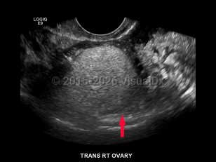 Ovarian cysts