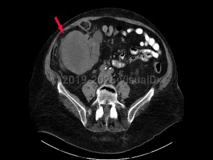 Renal cell carcinoma