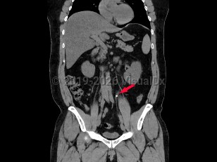 Ureteral calculus