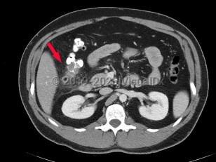 Diverticular disease