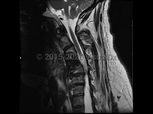 Imaging Studies image of Syringomyelia - imageId=6844351. Click to open in gallery.  caption: '<span>Cystic space/collection within the spinal cord, secondary to trauma</span>.'