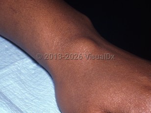 Clinical image of Ganglion cyst - imageId=6858683. Click to open in gallery.  caption: 'A skin-colored subcutaneous nodule on the dorsal wrist.'