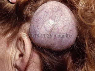 Meningioma