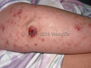 Lymphomatoid papulosis