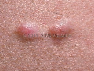 Cutaneous leiomyoma