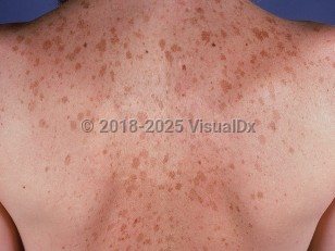 Clinical image of Solar lentigo - imageId=689350. Click to open in gallery.  caption: 'Many large tan macules on the back.'