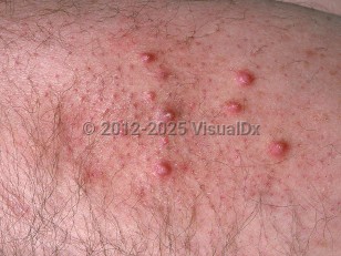 Clinical image of Kyrle disease - imageId=690314. Click to open in gallery.  caption: 'A close-up of several hyperkeratotic, deep pink papules, some with a prominent whitish portion centrally.'