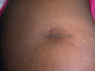 Lupus panniculitis