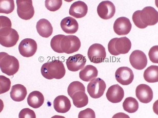 Lab image of Babesiosis - imageId=6968796. Click to open in gallery.  caption: '<span>Blood smear showing various intraerythrocytic forms of babesia.</span>'
