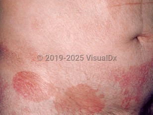 Cutaneous T-cell lymphoma